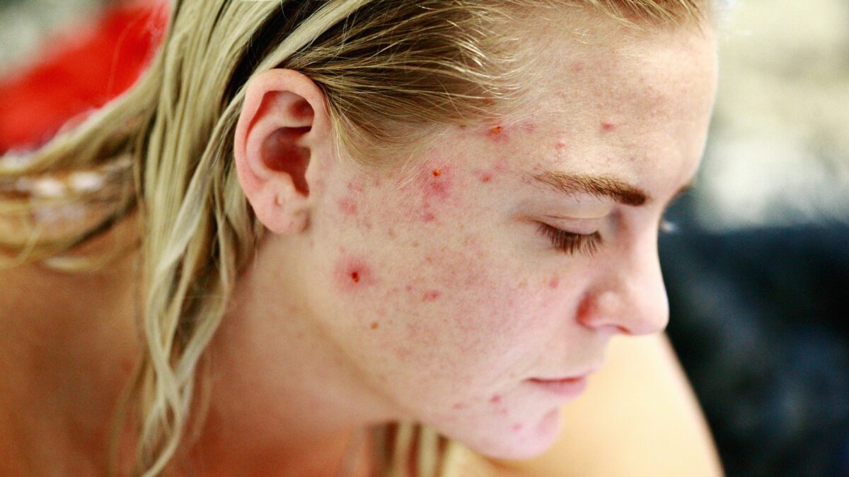 consejos evitar acne